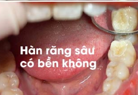 Hàn răng có bền không